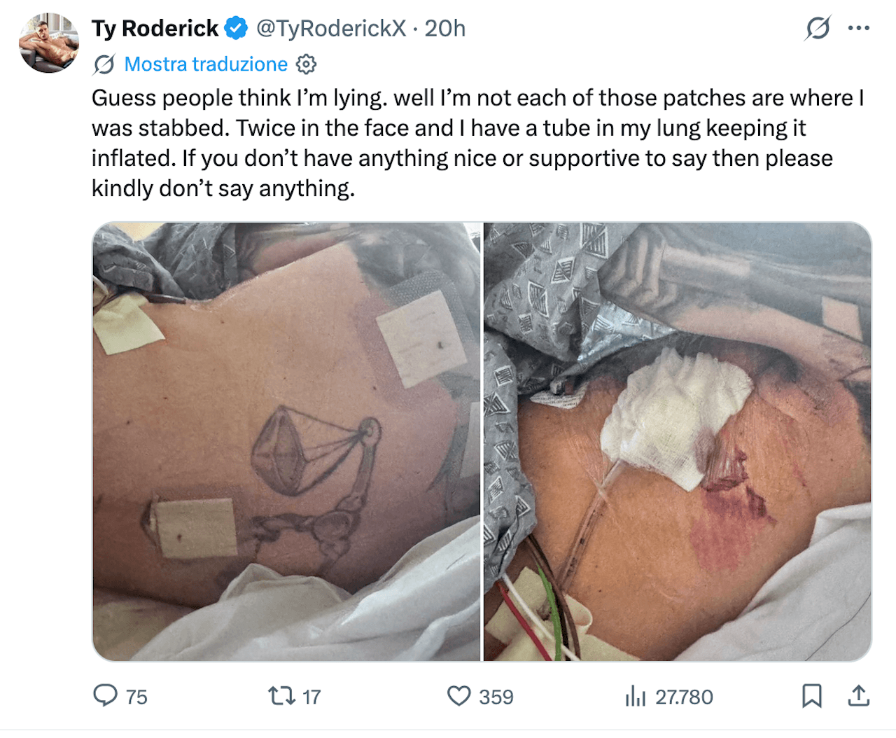 Ty Roderick, il pornodivo queer accoltellato e in ospedale: "Un attacco brutale e terrificante" - Ty Roderick in ospedale - Gay.it